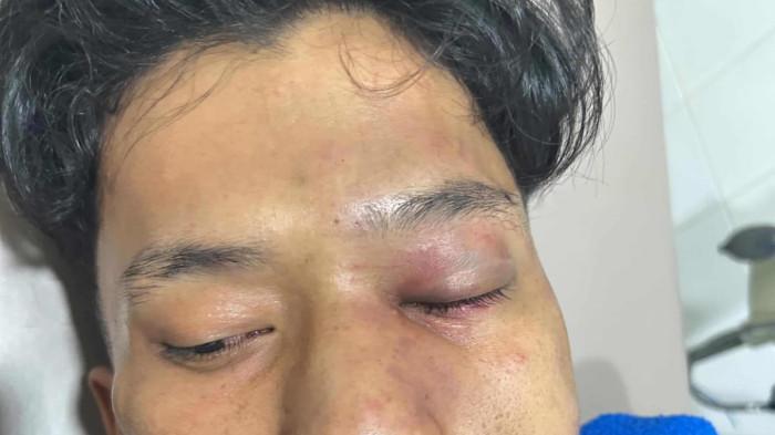 PENGEROYOKAN DI BATAM SAAT LEBARAN - Luka yang dialami Andre, warga Kaveling Melati, Kelurahan Sei Pelunggut, Kecamatan Sagulung, Kota Batam, Provinsi Kepulauan Riau (Kepri). Ia dikeroyok sekelompok orang di jalan dapur 12, Sagulung, Minggu (22/3/2026) malam.