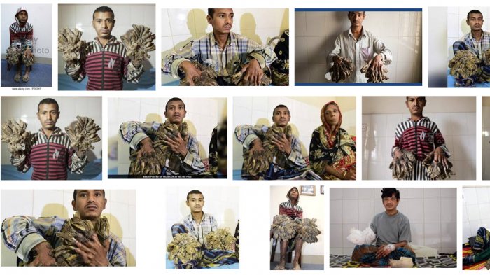 Masih Ingat dengan Tukang Becak yang Dijuluki Manusia Pohon? Ternyata Begini Kondisinya Kini