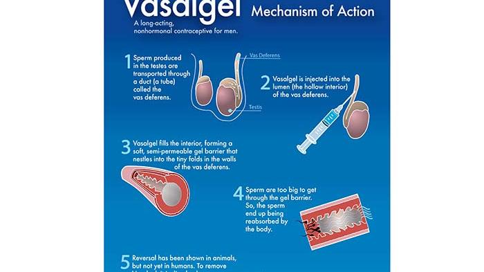 Kaum Adam Bakal Punya 'Pil KB' Sendiri, Bukan Diminum Layaknya Tablet tapi Disuntikan ke Testis