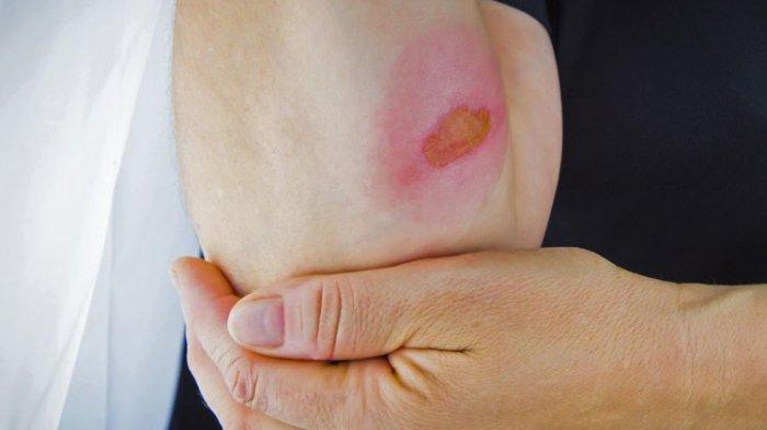 Mengenal 5 Jenis Bekas Luka, Bisa Diatasi dengan Bahan Alami Rumahan