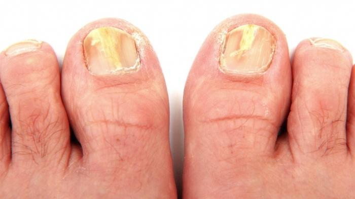 Hati Hati! Kuku Rapuh Dan Sering Patah Bisa Menandakan 5 Penyakit Berbahaya Ini Loh, Coba Cek!