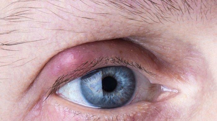 Kompres Air Hangat hingga Pakai Kantong Teh, Inilah 7 Cara Mengatasi Mata Bintitan