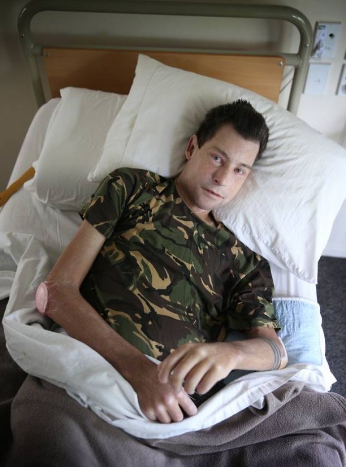 Inilah Scleroderma, Penyakit Langka Bikin Tubuh Keras Membatu. Warga Selandia Baru Banyak Terkena