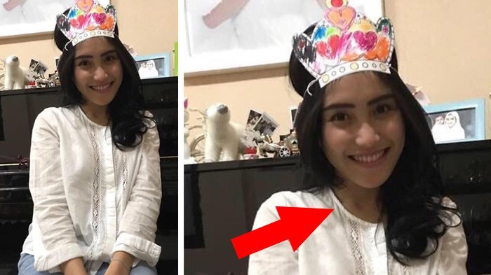 Tanda Merah di Leher Ayu Ting Ting Ini Bikin Heboh, Kegigit Tawon Atau?