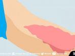 ilustrasi-ruam-kulit.jpg
