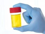 urine_20170322_084146.jpg