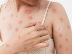 Monkeypox-atau-cacar-monyet.jpg