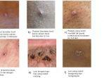 benjolan-dan-lesi-cacar-monyet-monkeypox.jpg