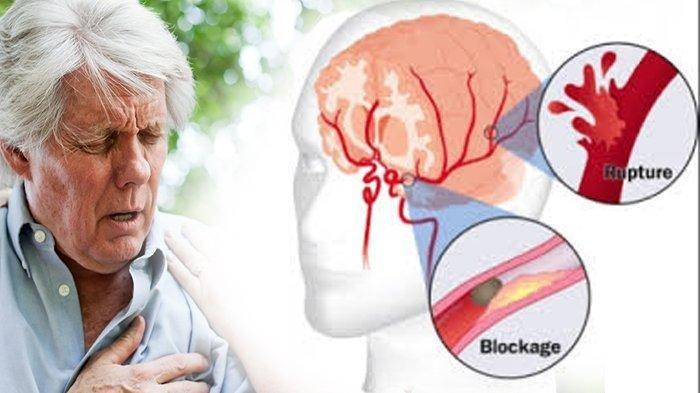 Stroke Lebih Baik Dicegah Daripada Diobati, Kenali Gejala Awalnya