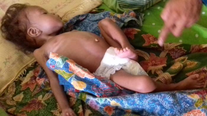 Dinkes Bangka Barat Sebut Dua Ribu Anak -anak di Wilayahnya Terkena Gizi Buruk