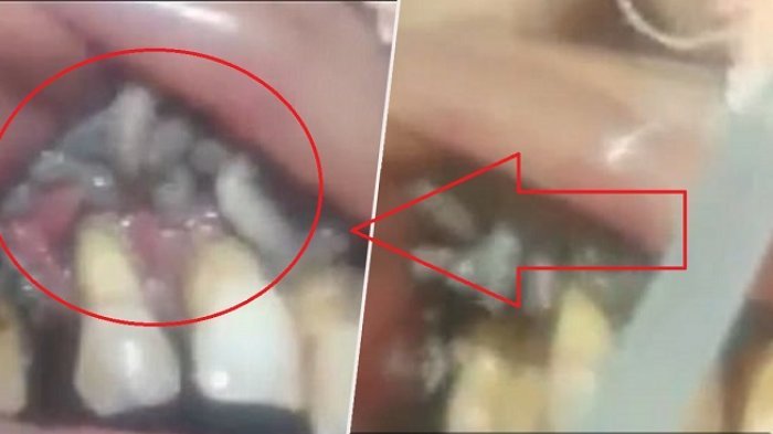 Dokter Gigi Ini Kaget Saat Temukan Hewan Mengerikan di Dalam Mulut Pasien