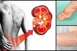 Jangan Anggap Remeh, Inilah 10 Gejala Tanda Ginjal Anda Bermasalah