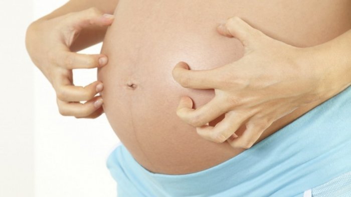 Wahai Ibu-ibu, Ini lho Penyebab dan Cara Mengatasi Perut Gatal Saat Hamil