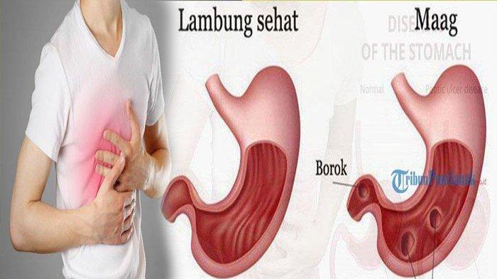 Cara Menjaga Kesehatan Lambung agar Tetap Sehat, Tips dr Saddam Ismail