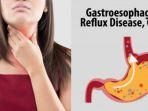 5-makanan-yang-cocok-bagi-penderita-gerd-ampuh-redakan-asam-lambung.jpg