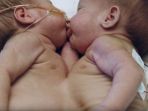 foto-bayi-kembar-dengan-tubuh-menyatu_20180705_165309.jpg