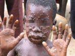 kondisi-bocah-afrika-yang-badannya-terserang-virus-cacar-monyet-atau-monkeypox.jpg