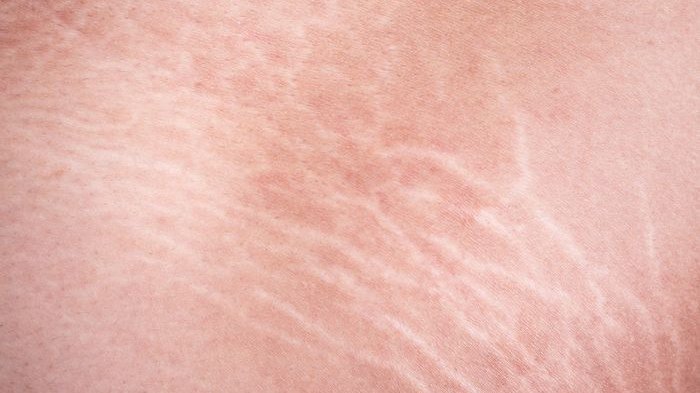 Masih Remaja Sudah Punya Stretch Mark? Ini Penyebab dan Cara Menghilangkannya