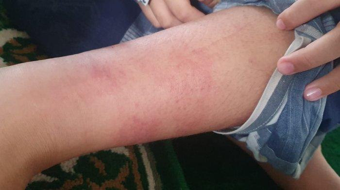 Korban Trauma, Keluarga Santri yang Dianiaya di Tamansari Minta Proses Hukum Sampai Tuntas