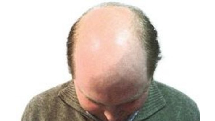 Ini 5 Cara Tak Biasa Atasi Kebotakan dari Berbagai Negara, Termasuk Pakai Urin Sapi