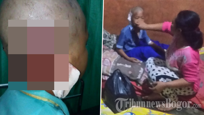 Diserang Anjing Lapar Sepulang Jajan Di Warung, Kepala Bocah Ini Alami Luka Parah