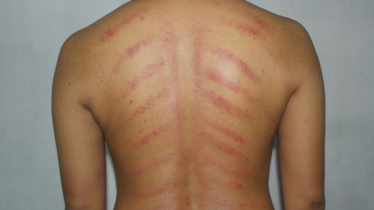 Ampuh Usir Masuk Angin, Kerokan Disebut Bisa Sebabkan Stroke, Mitos atau Fakta? Ini Kata Dokter