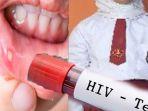 sariawan-dan-hiv.jpg