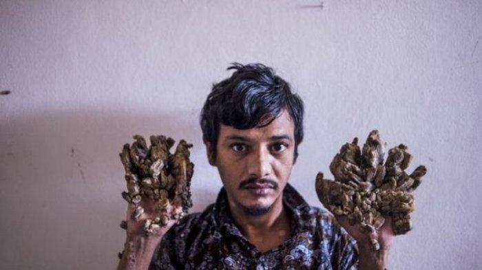 'Manusia Pohon' asal Bangladesh Ingin Tangannya Diamputasi, Tak Kuat Menahan Rasa Sakit