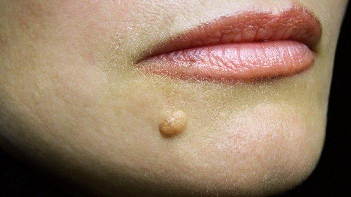 Apa Itu Kutil? Jangan Anggap Remeh Bila Muncul di Tubuh Anda, Bisa Sembuh Pakai Bumbu di Dapur Ini
