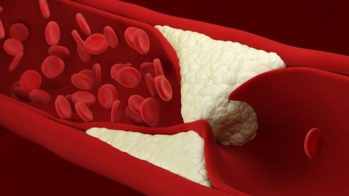 Tanpa Sadar, Makanan Penyebab Kolesterol Tinggi Sering Dikonsumsi, Apa Saja?