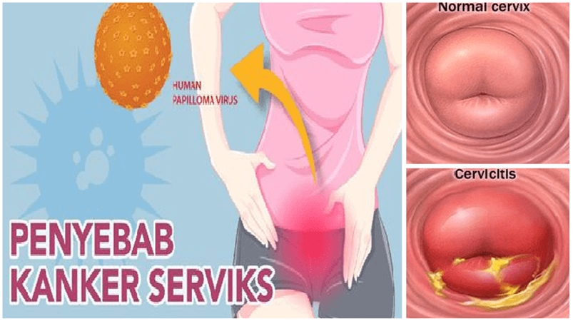 ilustrasi-wanita-terkena-kanker-serviks.jpg