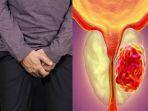 Ilustrasi-kanker-prostat.jpg