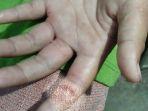 Jari-telunjuk-anak-nyaris-putus-setelah-digergaji-orang-tua-korbanv.jpg