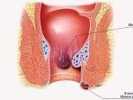 hemoroid-ambeien-wasir.jpg