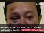 wajah-herry-wirawan-lebam.jpg