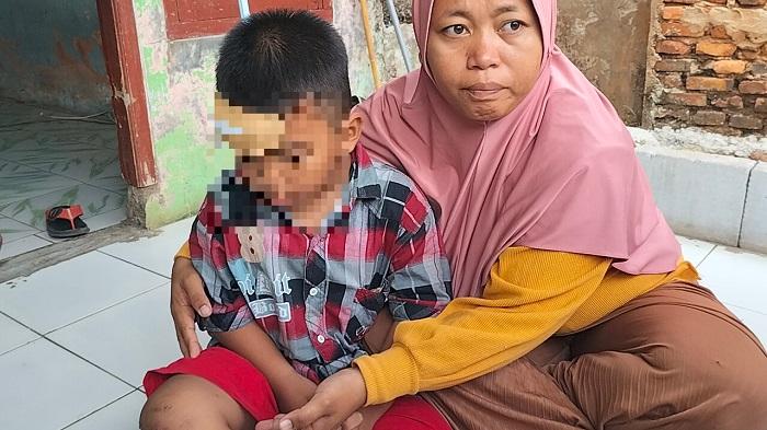 Bocah 7 Tahun Korban Gigitan Monyet Liar di Cipayung Depok Akhirnya Disuntik Anti Rabies