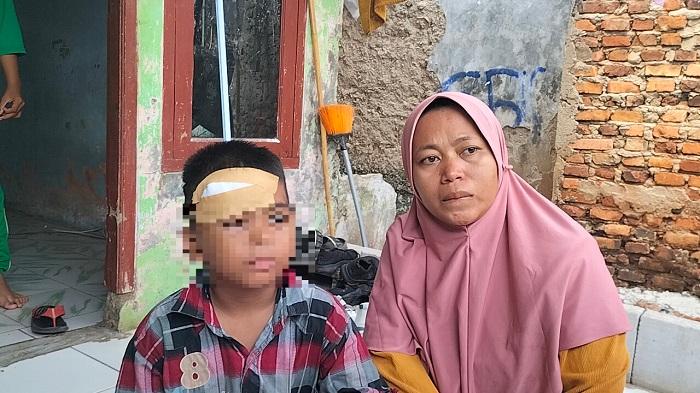 Bocah yang Diserang Monyet Liar di Cipayung Depok Alami Luka Robek Hingga 10 Jahitan di Dahi