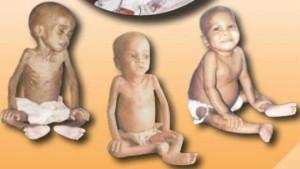 anak-kurang-gizi.jpg