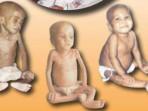 anak-kurang-gizi.jpg