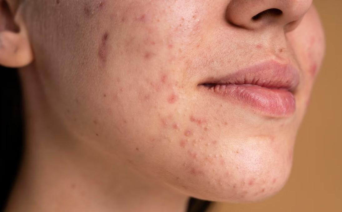 ILUSTRASI-wajah-seorang-wanita-kena-jerawat.jpg