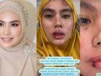 Kartika-Putri-mengalami-ruam-wajah.jpg