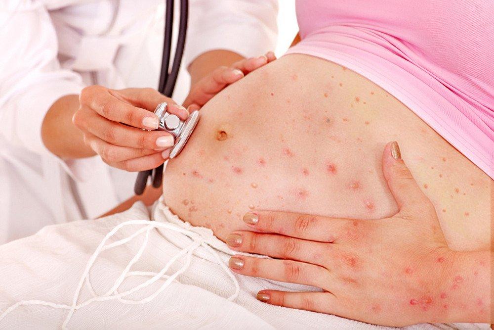 Waspada Cacar Air Pada Ibu Hamil