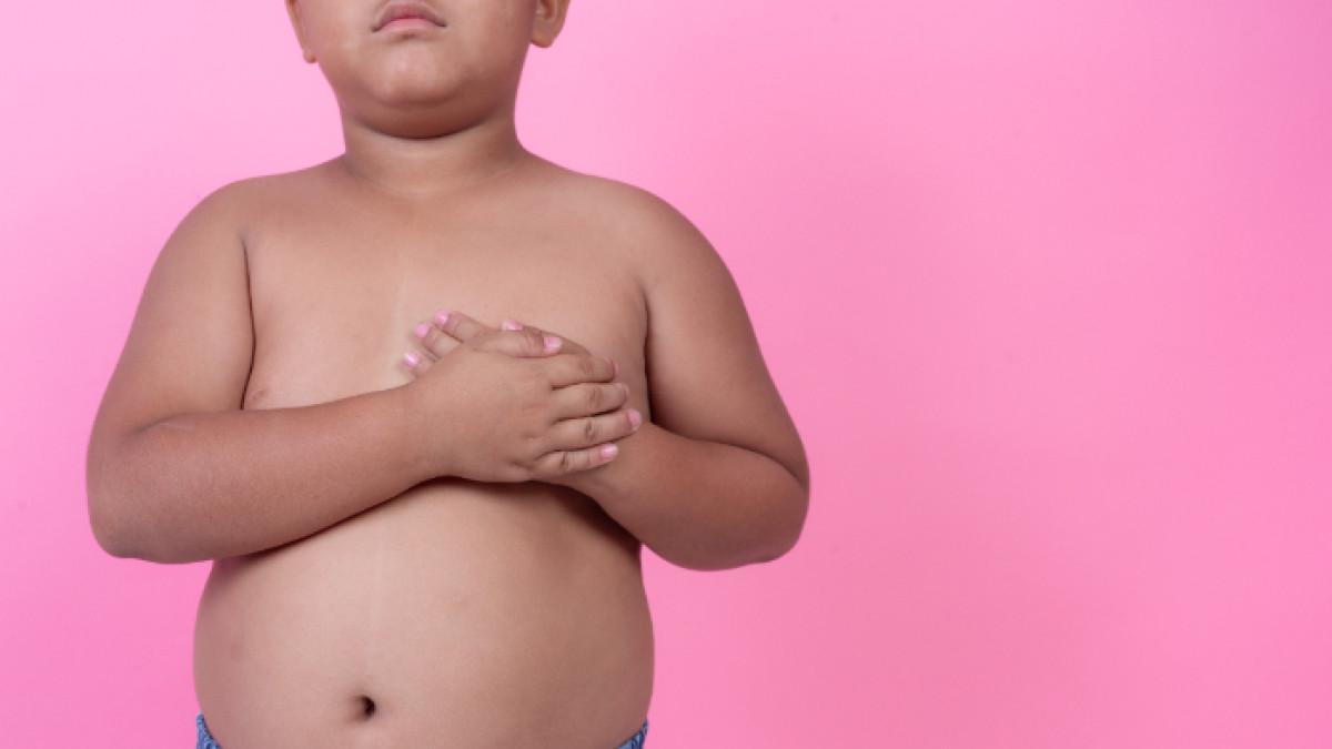 Ilustrasi anak obesitas, berikut ini cara menurunkan berat badan anak yang mengalami obesitas