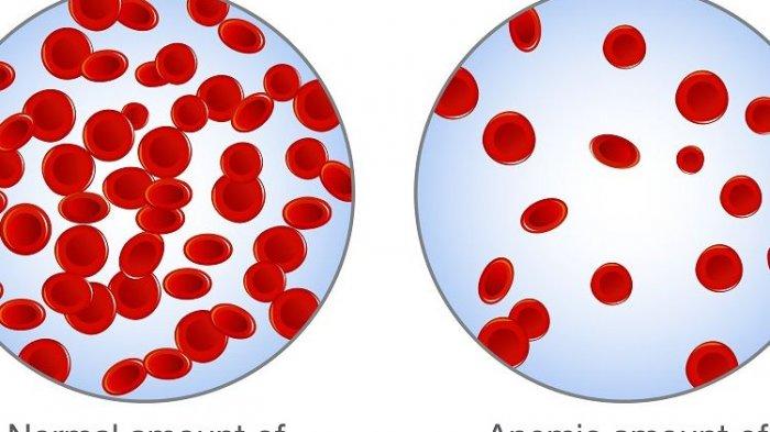 Benarkah Anemia Dapat Dicegah dengan Makanan? Berikut Ulasan Dokter