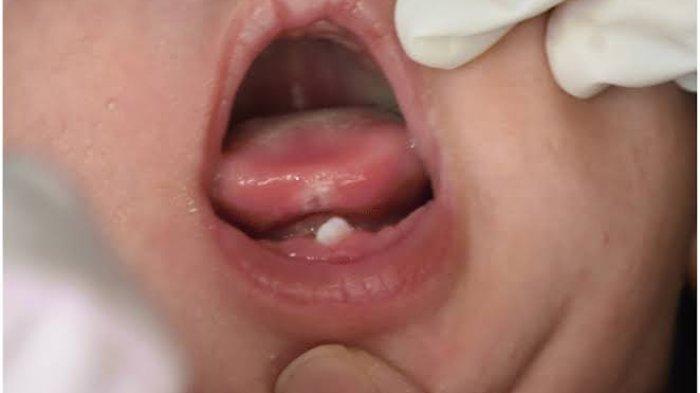 drg. Anastasia Sebut Natal Maupun Neo Natal Teeth Tidak Terjadi Secara Spesifik