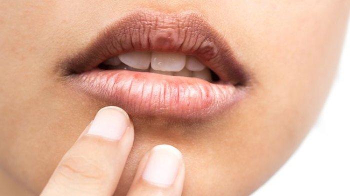 Berikut Ini Tips Mengatasi Bibir Kering, Justru Tak Boleh Dijilat Pakai Lidah
