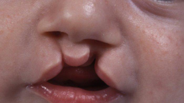 Dokter Sebut Tak Selalu Faktor Genetik Menjadi Penyebab Kelainan Bibir Sumbing, Simak Ulasan Berikut