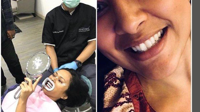 drg. Mery Paparkan Seputar Prosedur Bleaching Gigi hingga Efek Setelah Tindakan