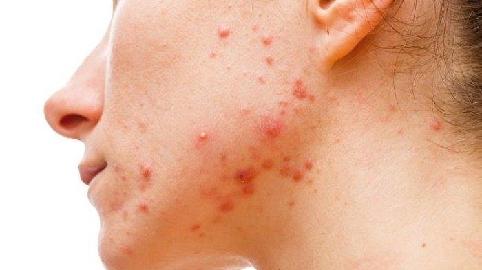 Mengenal Penyebab dan Ciri-ciri Breakout yang Disampaikan oleh dr. Amelica Oksariani, M.Biomed