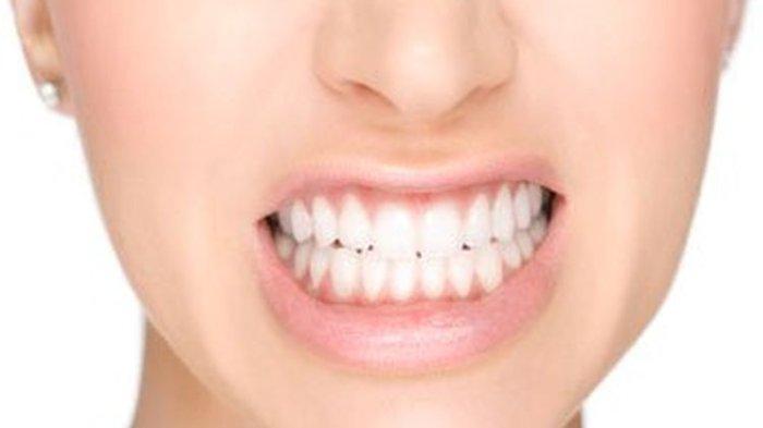 Pasien Bruxism yang Melakukan Terapi Akan Mengurangi atau Menghilangkan Kebiasaan Tersebut?